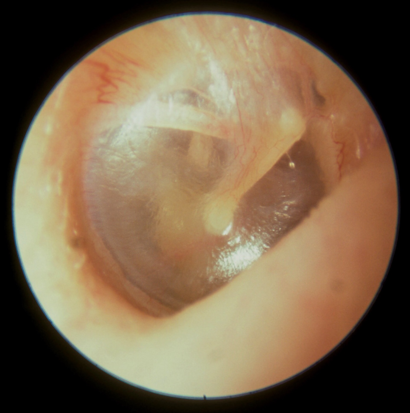 A healthy eardrum seen through an otoscope